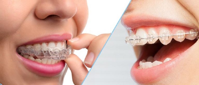 Considering Braces As An Adult You Want To Think About Invisalign