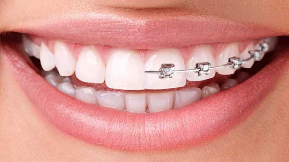 Do Invisible Braces Work As Well As Metal Braces?