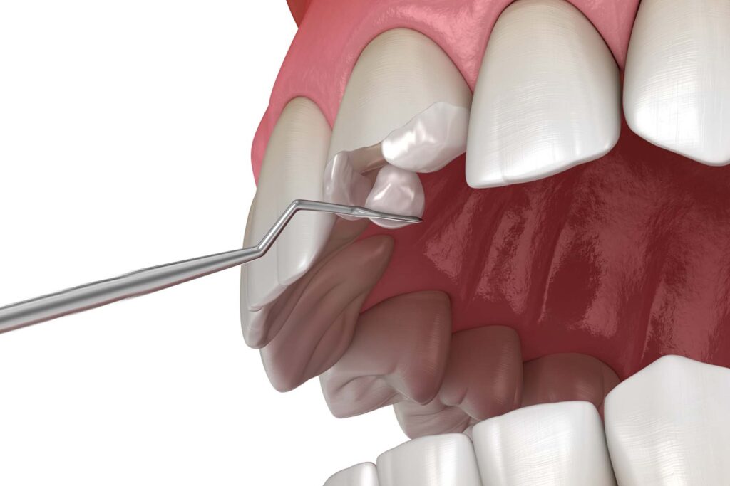 Broken or Chipped Tooth