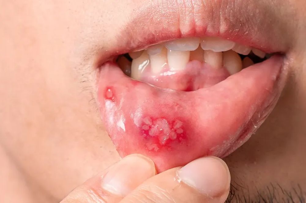 What-Is-The-Difference-Between-A-Canker-Sore-And-A-Mouth-Ulcer