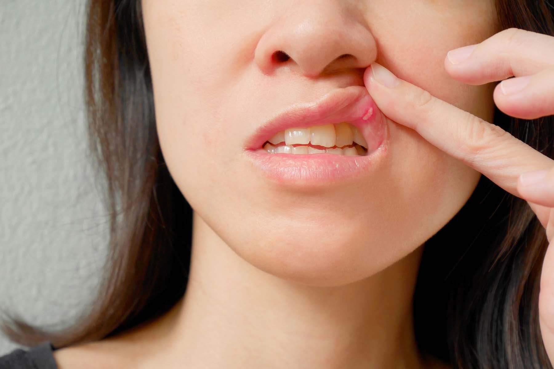 How Do You Get Rid Of Canker Sores?